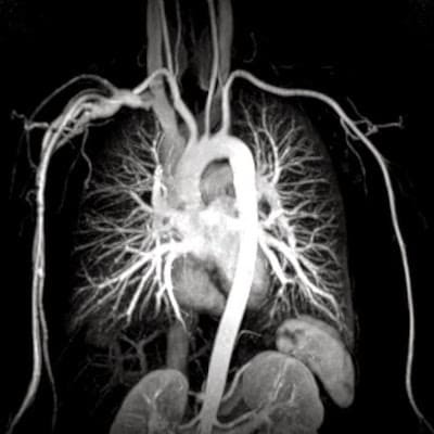 снимок МРТ аорты грудного отдела